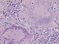 Giant cells in Sarcoidosis
