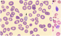 Cabot rings and marked anisopoikilocytosis in Imerslund-Gräsbeck syndrome