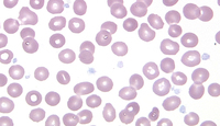 Gray Platelet Syndrome