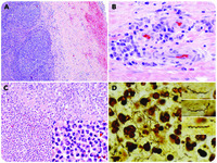 Syphilitic lymphadenitis with abscess formation involving cervical lymph nodes