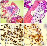 Chewing the bone: bone marrow with adult T-cell leukemia/lymphoma