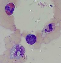 Marrow involvement in cutaneous T-cell lymphoma