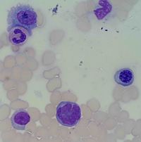 Marrow involvement in cutaneous T-cell lymphoma