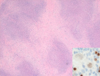 CHL - Nodular Sclerosis