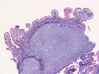 Duodenal-type follicular lymphoma