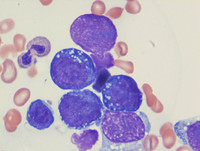 Pronormoblasts with vacuoles