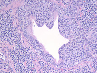 Lymphoepithelial lesion