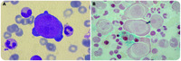 Severe acute anemia attributable to concomitant occurrence of AIHA with PRCA induced by parvovirus B19 infection