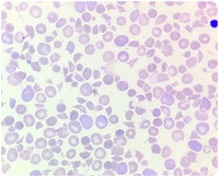 A neonate presenting with jaundice, anemia, and thrombocytopenia