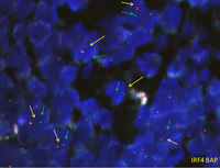LBCL-IRF4-breakapart-FISH