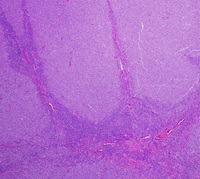 LBCL-with-IRF4-HE-Low-40x