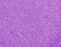 LBCL-with-IRF4-HE-medium-200x