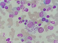 Leishmania visualization on bone marrow aspiration sample 1