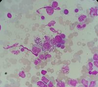 Leishmania visualization on bone marrow aspiration sample 7