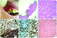EBV mucocutaneous ulcer: a new entity of WHO 2017