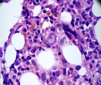 Parvovirus in biopsy