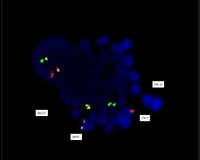 Interphase nuclei and Metaphase showing t(9;22)(q34;q11.2)