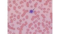 Rouleaux in a Peripheral Smear, Multiple Myeloma