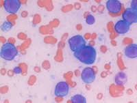 Plasma Cells in Bone Marrow Aspirate, Multiple Myeloma