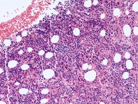hepatosplenic T cell lymphoma 2