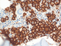 Multiple Myeloma, CD 138 Immunostain