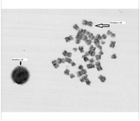 GTG banded Interphase and Metaphase cells cultured from bone marrow aspirate