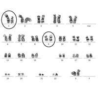 t(1;9)(p13;p12) as a sole abnormality in a paediatric acute lymphoblastic leukemia patient
