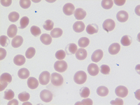 Peripheral Blood with Bite Cells