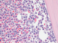 Acute Myeloid Leukemia with inv(16)
