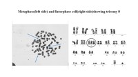 Trisomy 8 as sole abnormality in Acute Myeloid Leukemia, AML