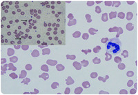 Cryoglobulin-induced red blood cell morphologic changes