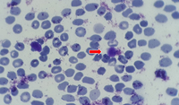 presentation of many large platelets in peripheral blood 2