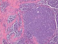 Merkel cell carcinoma