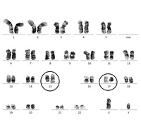 Karyotype showing classic translocation t(15;17)(q24;q21)