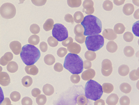 B-lymphoblastic leukemia, BCR-ABL1-like