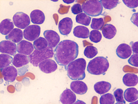 BALL-marrow-aspirate