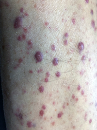 Leukemia Cutis Clinical Presentation 3