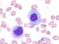 Monoblast and immature monocytic cell in peripheral blood