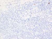 EBVPlasmablastic-lymphomaCD20