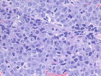 EBVPlasmablastic-lymphomaHE