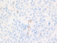 EBV+Plasmablastic lymphoma-PD1