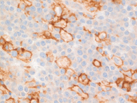 EBVPlasmablastic-lymphomaPDL1