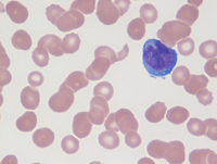 AML with biallelic CEBPA mutation