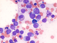 AMLCEBPAAspirate
