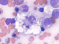 Intravascular-DLBCLAspirate