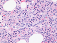 Intravascular-DLBCLBiopsy-HE