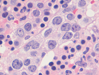 Intravascular-DLBCLBiopsy-HE