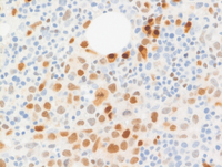 Intravascular-DLBCLMUM1