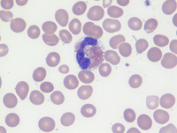 Myeloid/Lymphoid neoplasm with PCM1-JAK2