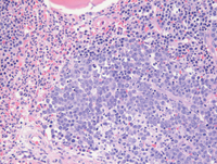 MPN-JAK2PCM1Biopsy-HE